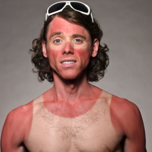 sunburn-ski_bum